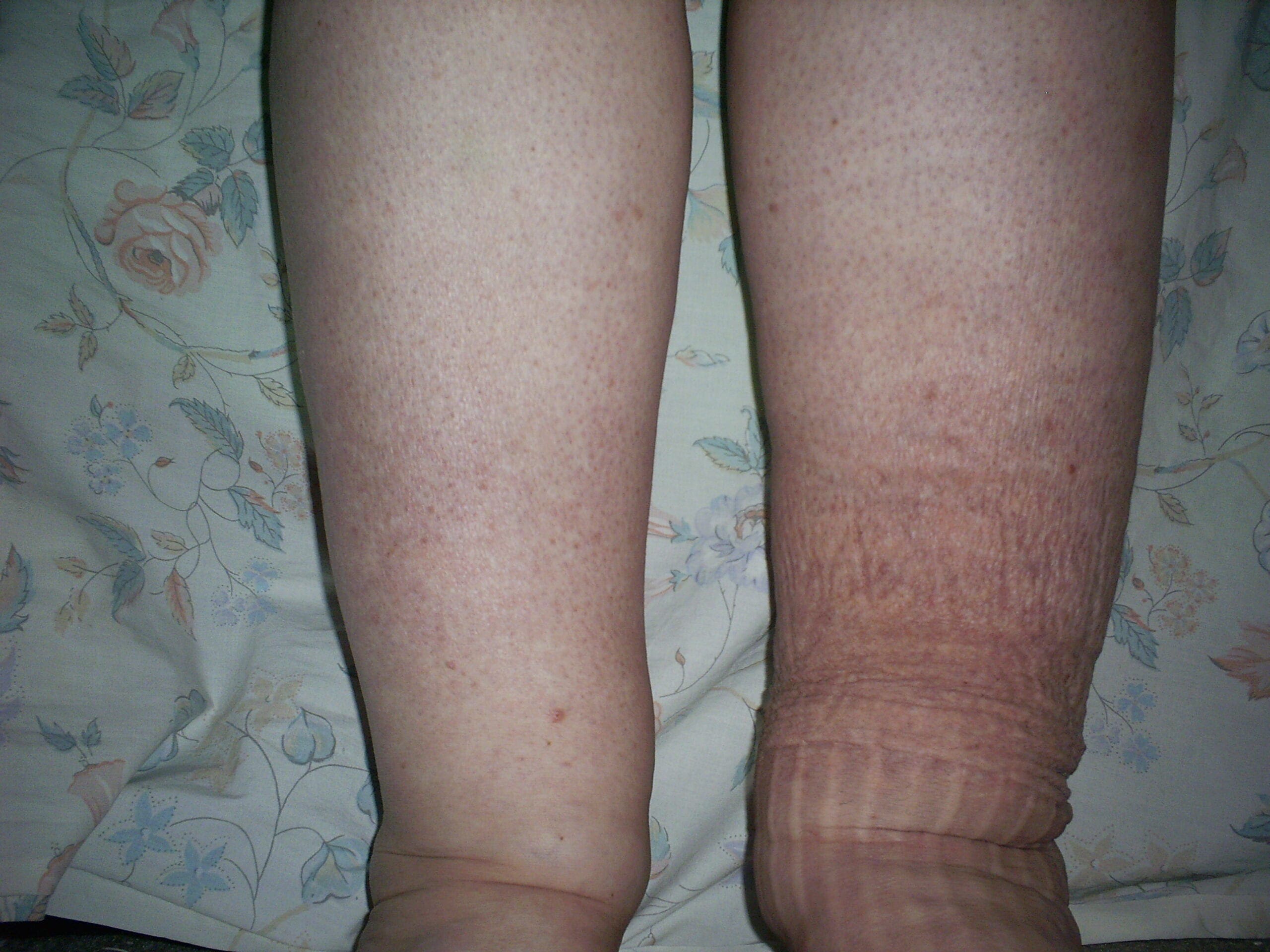 What is Lymphedema